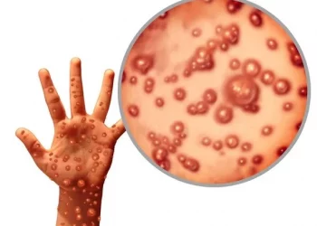 Kadinkes Sebut Isu Cacar Monyet di Ambon “HOAX”