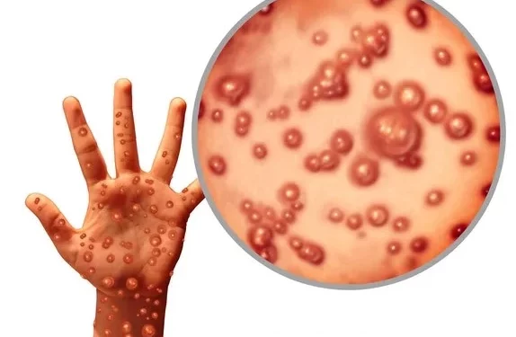 Kadinkes Sebut Isu Cacar Monyet di Ambon “HOAX”